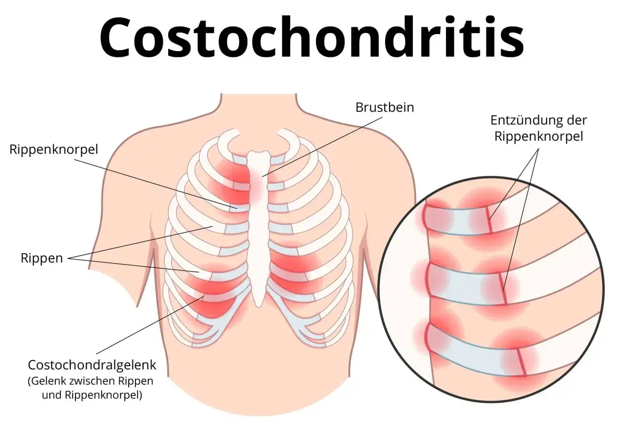 Brustbein und Rippenknorpel sind entzündet, was zu Schmerzen führt. Die Grafik zeigt die betroffenen Stellen.