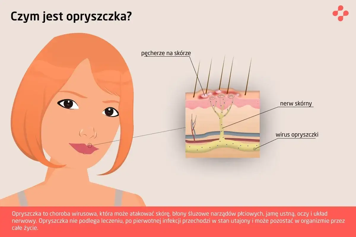 Wirus opryszczki (HSV) atakuje skórę, powodując pęcherze. Ilustracja pokazuje jego działanie w naskórku.