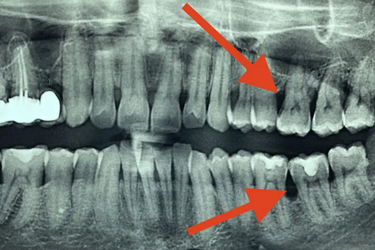 Radiografia dentale mostra segni di piorrea, con perdita ossea avanzata che potrebbe portare alla caduta dei denti.