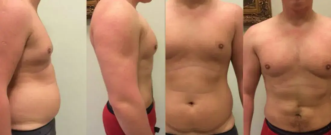 Rodzaje liposukcji porównanie