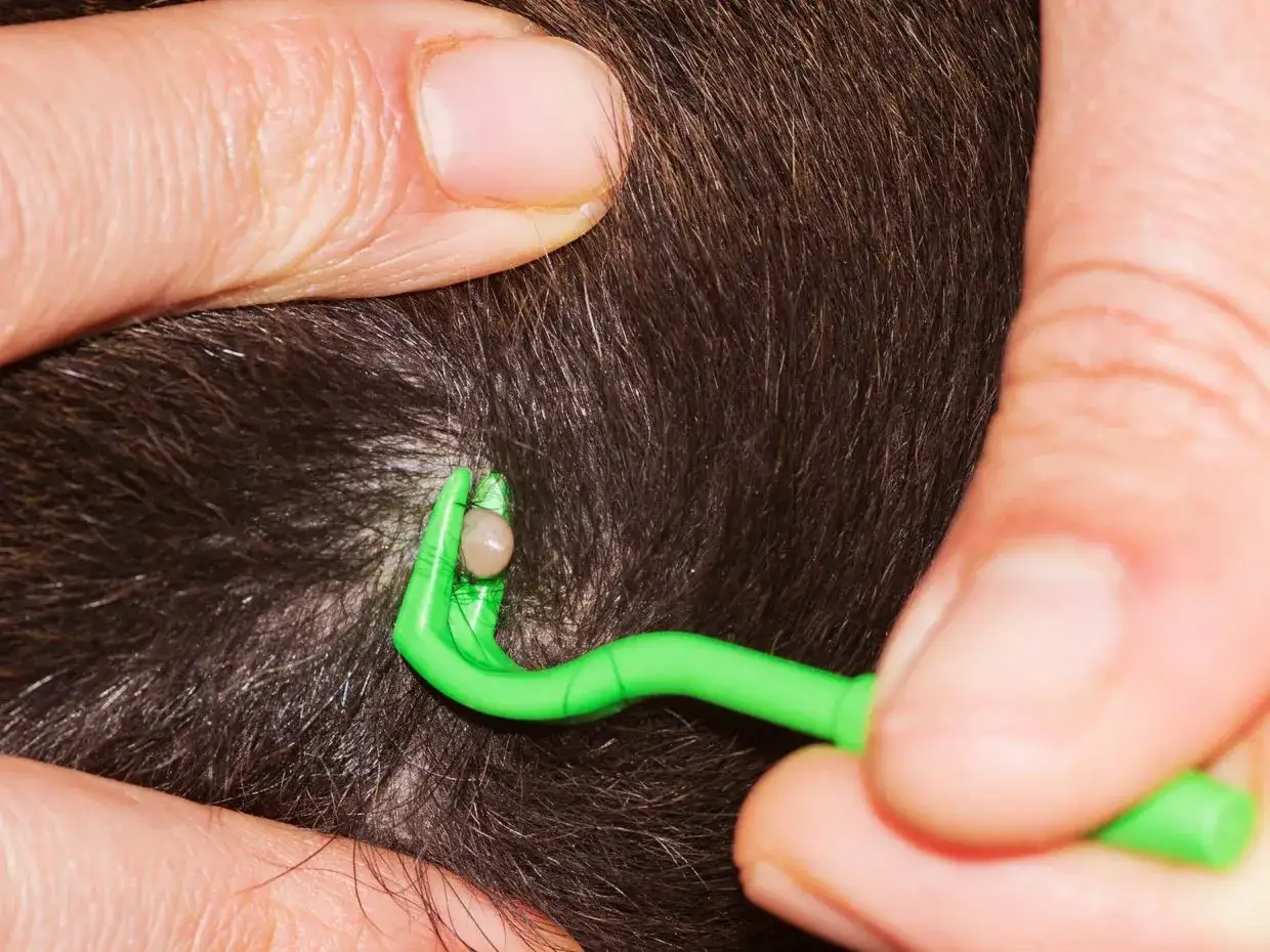 Rimozione di una zecca dal cuoio capelluto di un bambino con un apposito strumento.