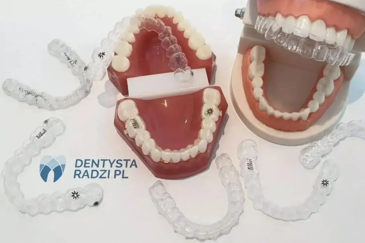 Modele szczęk z nakładkami ortodontycznymi. Zastanawiasz się nad leczeniem ortodontycznym? Cena może być kluczowa.