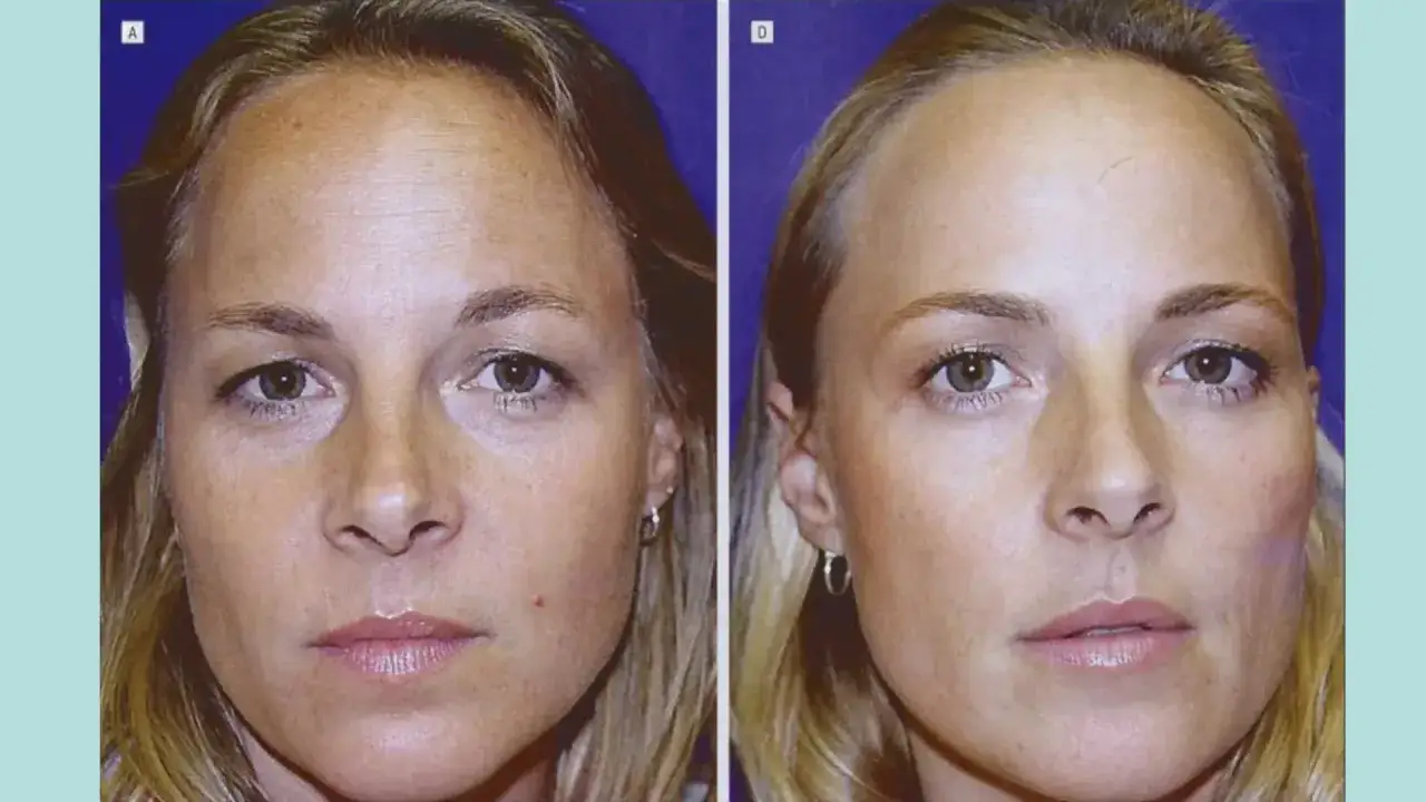 Przed i po zabiegu baby botox. Wygładzona skóra czoła i okolic oczu, zredukowane zmarszczki.