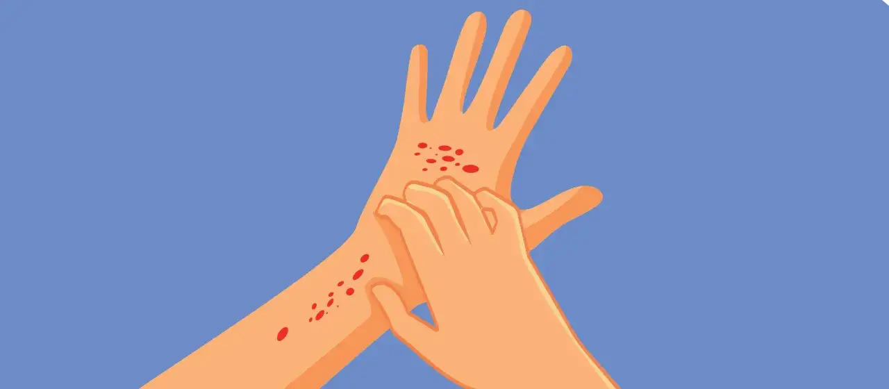 Mano con eruzioni cutanee rosse e pruriginose. Potrebbe essere un sintomo di MRSA, cos'&egrave; questa infezione batterica?
