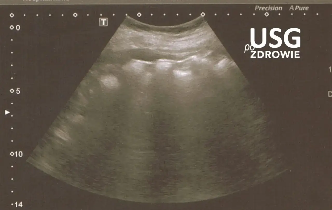 Obraz z USG jamy brzusznej jelita. Widoczne są struktury jelitowe, kt&oacute;re mogą wymagać dalszej diagnostyki.
