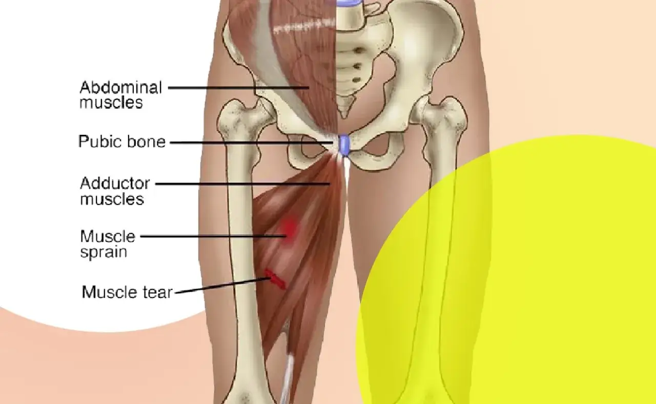 Anatomia mięśni przywodzicieli uda, z zaznaczonym naciągnięciem i naderwaniem mięśnia, wskazującymi na ból w pachwinie.