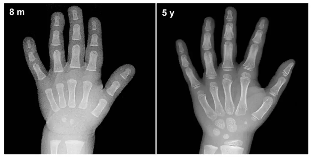 Radiografie di mani infantili a 8 mesi e 5 anni, mostrando la crescita ossea e l'impatto dell'ormone della crescita fino a che età.
