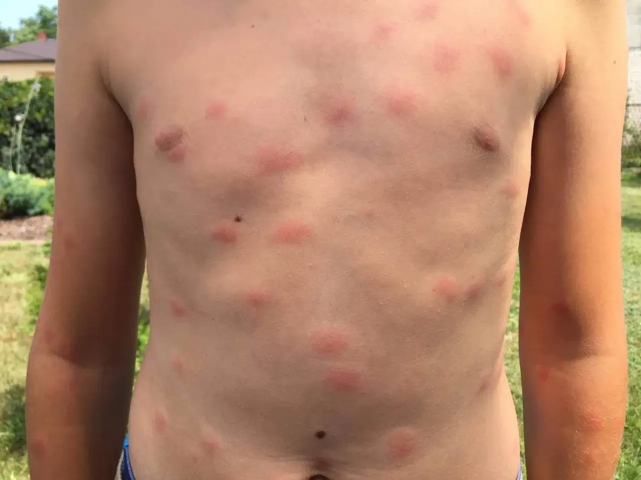 Dziecko ma na klatce piersiowej i ramionach liczne czerwone, swędzące bąble. To prawdopodobnie wysypka po kąpieli w jeziorze, być może od owad&oacute;w lub glon&oacute;w.