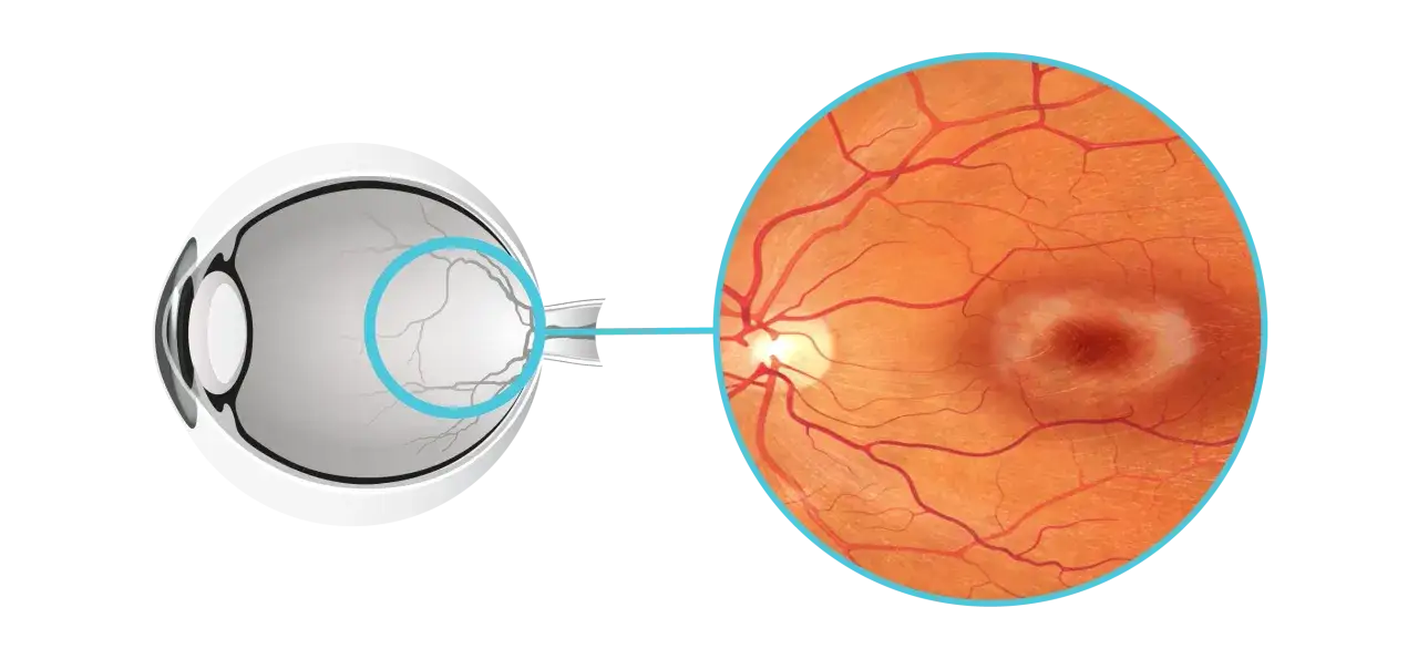 Sezione di un occhio che mostra la retina ingrandita, evidenziando i vasi sanguigni e un'area centrale alterata, tipica della miopia degenerativa.