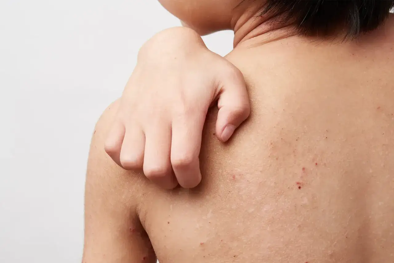 Une main se gratte le dos, révélant des rougeurs et des marques suggérant de l'eczéma.