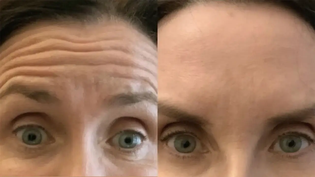 F&ouml;re och efter bilder p&aring; en panna som behandlats med hair botox. Rynkorna har sl&auml;tats ut.