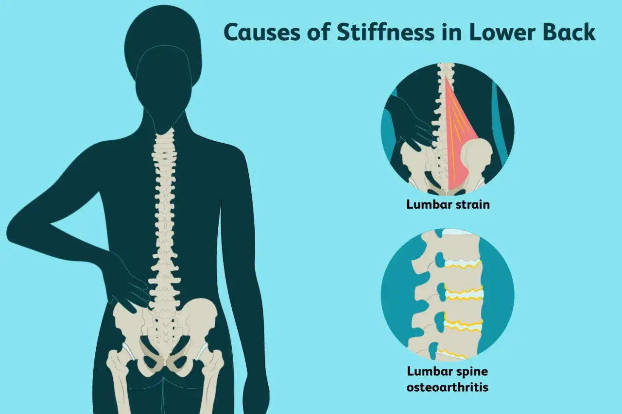 Illustration visar orsaker till stelhet i l&auml;ndryggen, inklusive lumbal belastning och artros. Reumatism i ryggen kan orsaka dessa besv&auml;r.