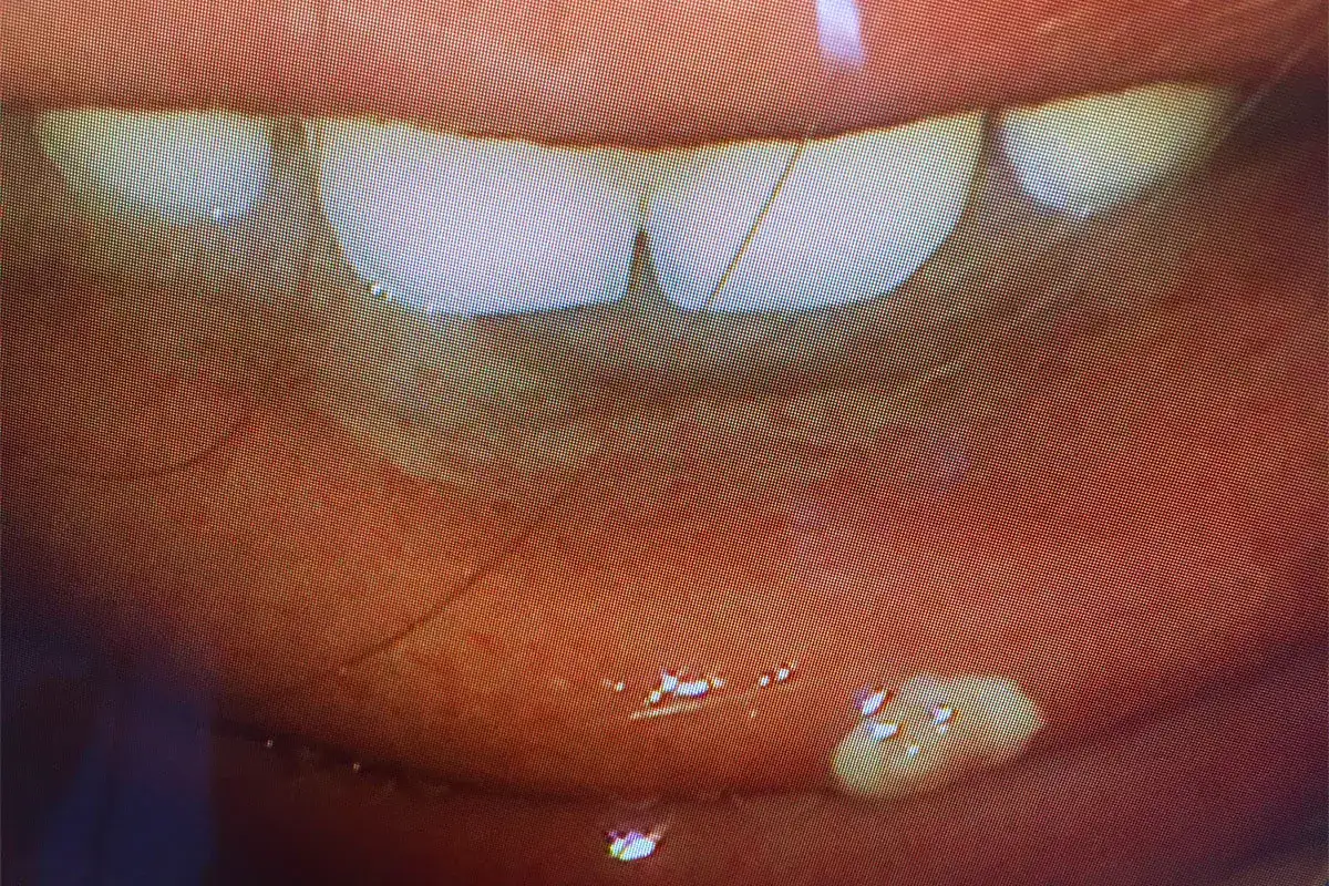 Nahaufnahme der Lippen und Zähne. Kleine, weiße Flecken sind sichtbar, die auf eine HPV-Infektion im Mund hindeuten könnten.