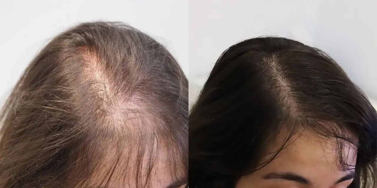 Antes y despu&eacute;s de un tratamiento de microneedling capilar. Se observa una mejora notable en la densidad del cabello.