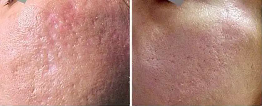 zabiegi na przebarwienia, laseroterapia, peeling chemiczny