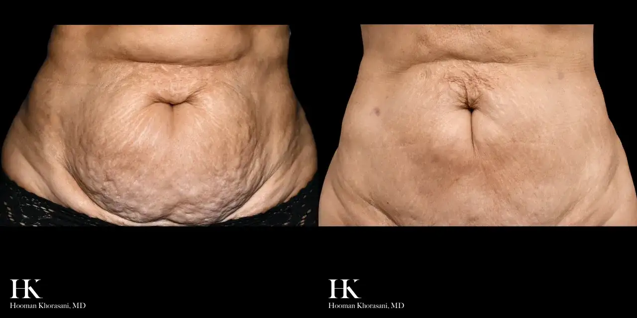 Abdomen antes y despu&eacute;s de radiofrecuencia, mostrando mejora en la flacidez y textura de la piel.
