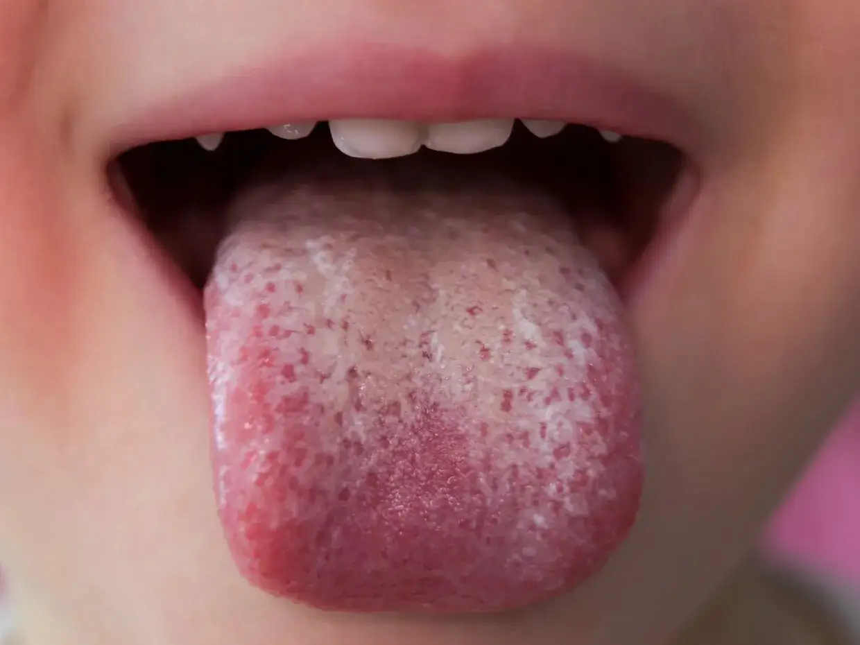 Bocca di bambino con lingua bianca e rossa, possibile segno di streptococco.