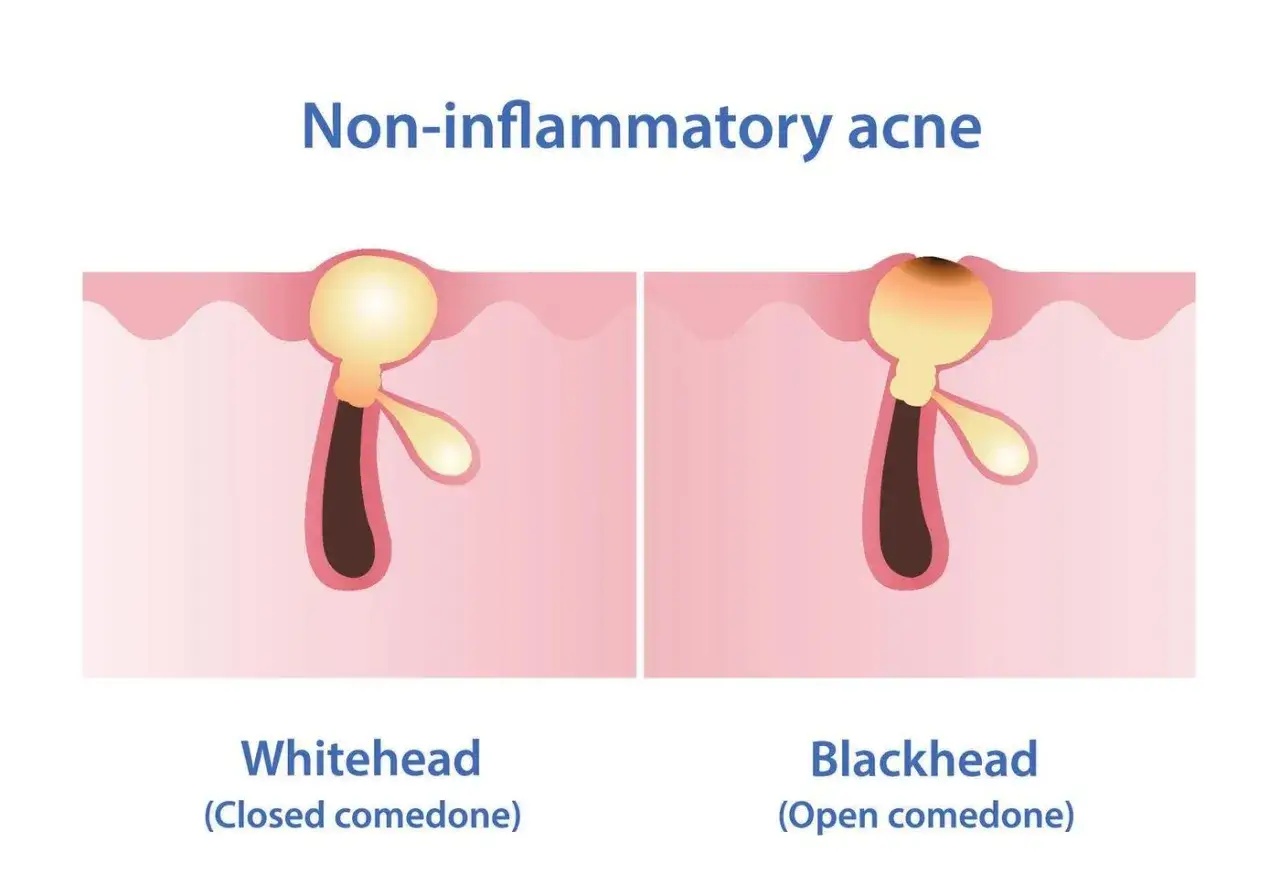 Illustrazione di comedoni: whitehead (comedone chiuso) e blackhead (comedone aperto) nella pelle.