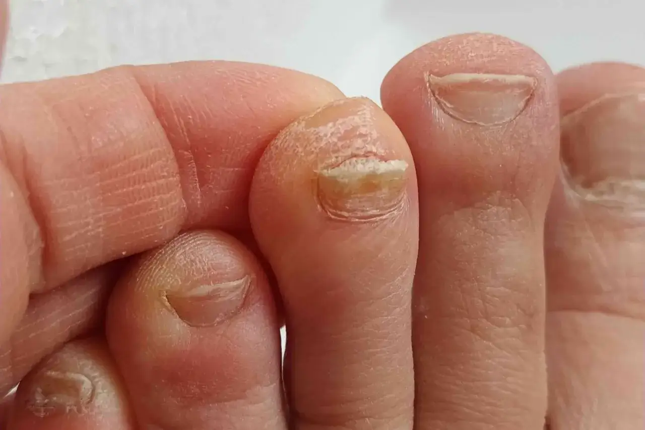 Gros plan sur les orteils d'un bébé, dont un ongle présente des signes de mycose, avec la peau sèche et squameuse autour.