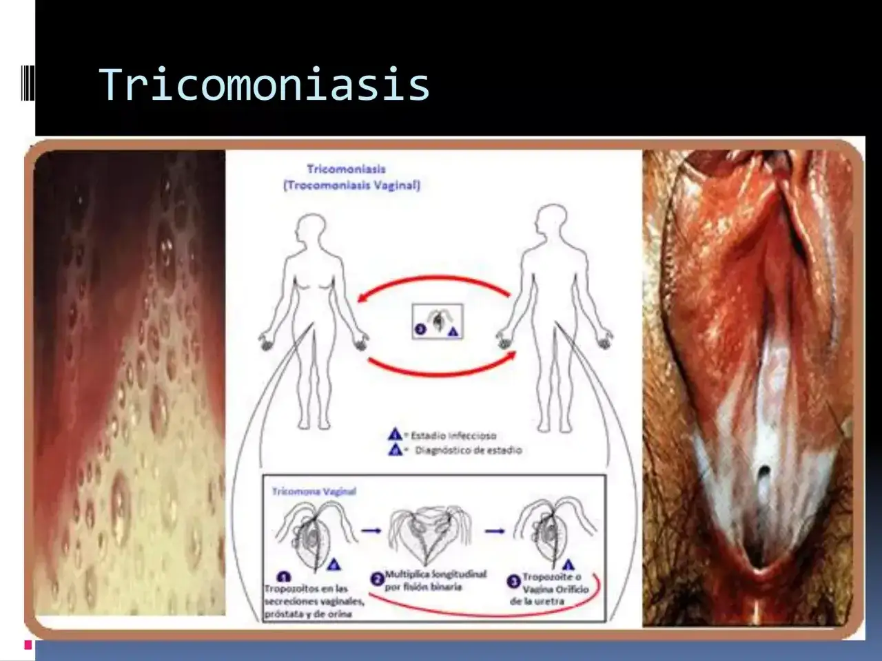 Ilustraci&oacute;n sobre tricomoniasis vaginal, mostrando transmisi&oacute;n, microscop&iacute;a del par&aacute;sito y s&iacute;ntomas visuales.