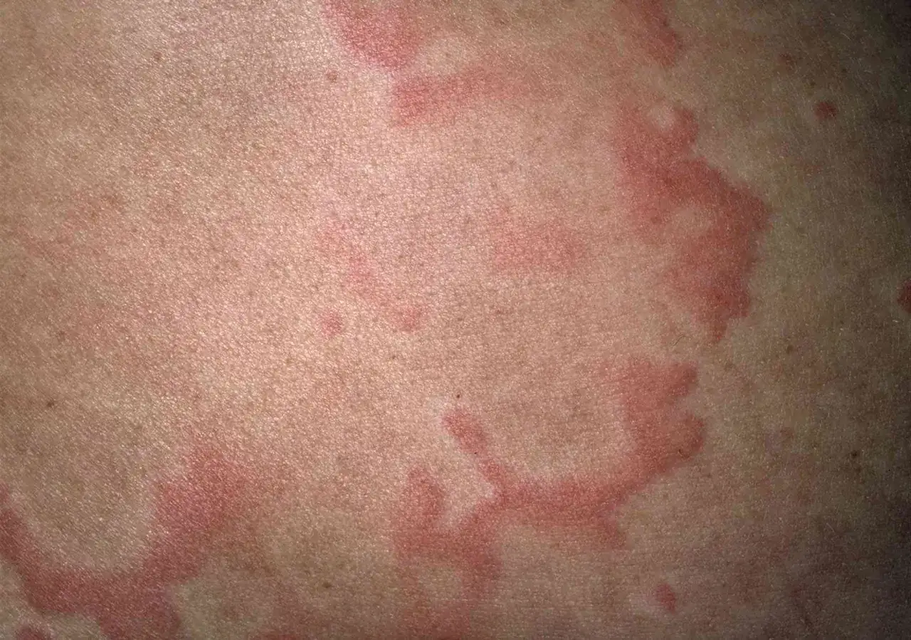 Grosses plaques rouges et surélevées sur la peau, typiques d'une urticaire après la douche.