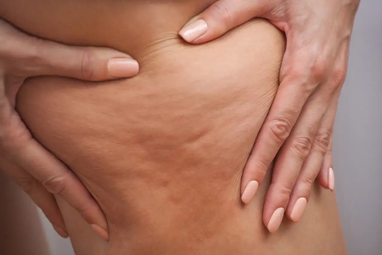 Mains pinçant la peau, révélant les capitons cellulite. La texture de la peau est visible, avec des plis et des irrégularités.
