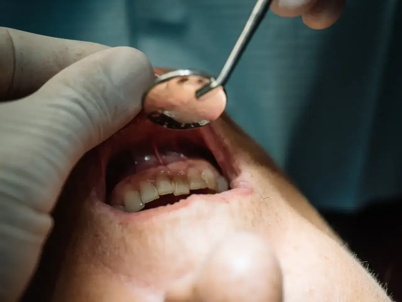 Dentysta bada zęby i dziąsła pacjenta za pomocą lusterka. Widoczna jest ropa na dziąśle, co może wskazywać na stan zapalny.