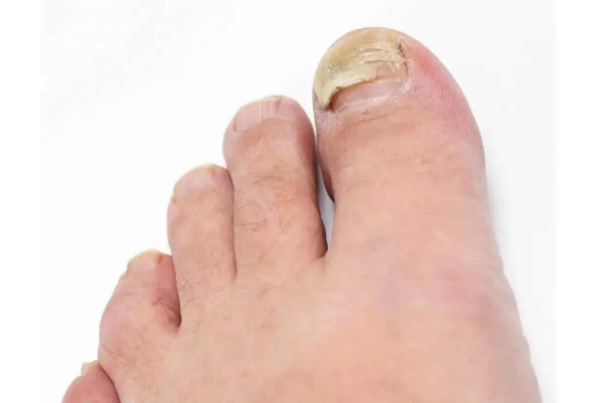 Gros plan sur un pied montrant un ongle qui se décolle, jauni et épaissi, signe d'une mycose.