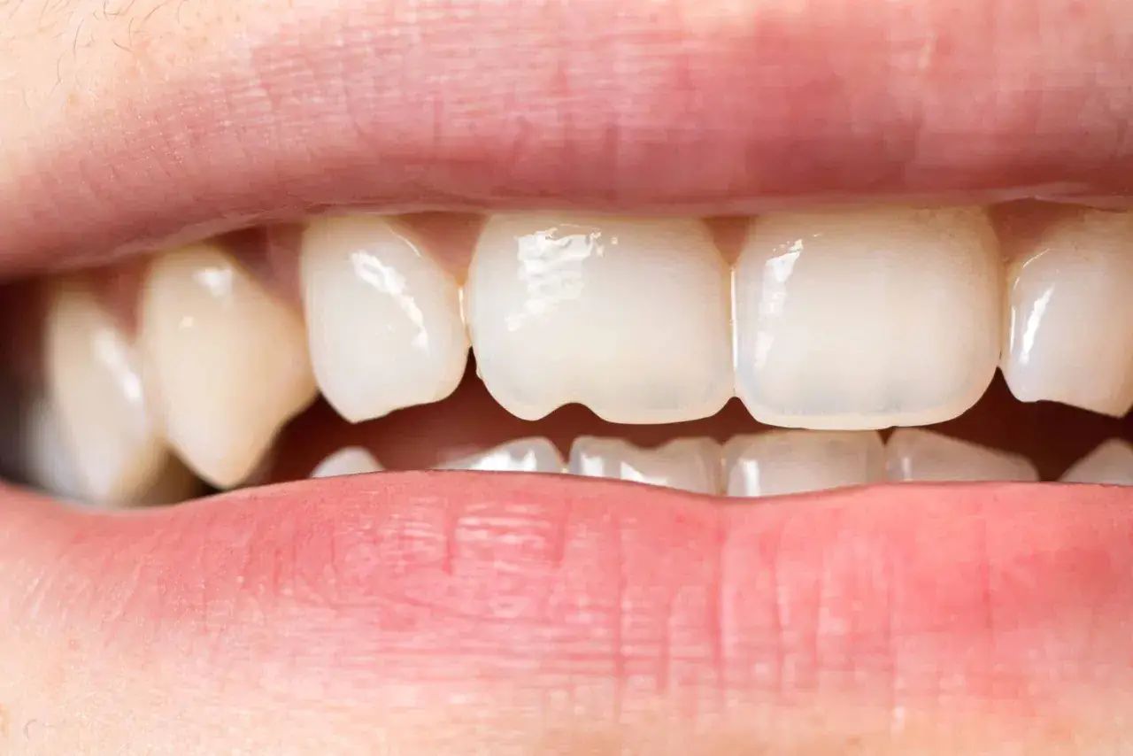 Primer plano de una boca mostrando dientes frontales con peque&ntilde;as grietas en los bordes incisales.
