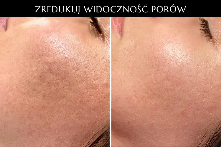 makijaż blizny potrądzikowe przed po