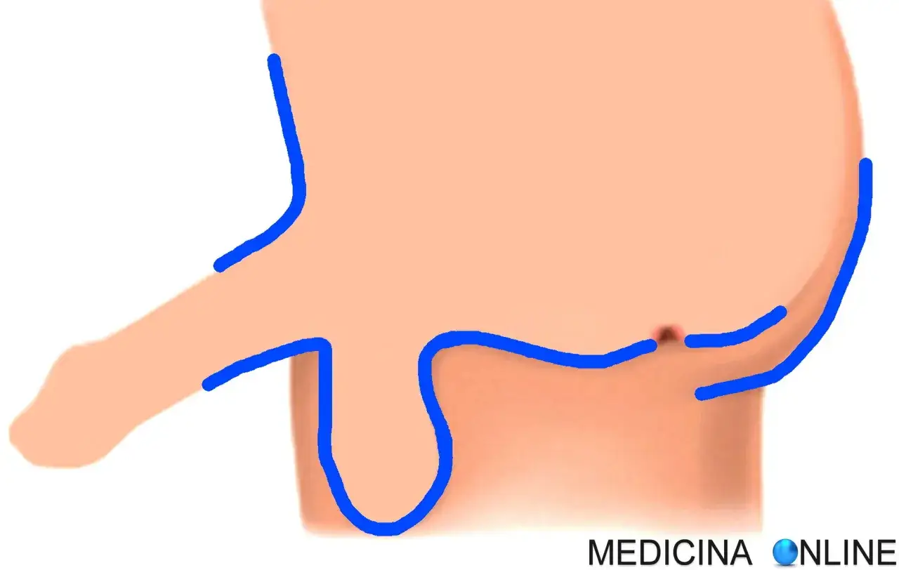 Illustrazione anatomica di parti intime maschili con contorni blu. Potrebbe rappresentare un trattamento con luce pulsata per la depilazione.