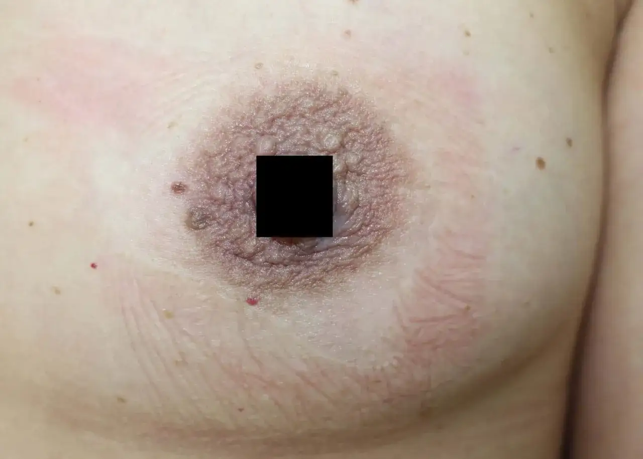 Apparition d'un grain de beauté sur le mamelon, signe possible de grossesse.