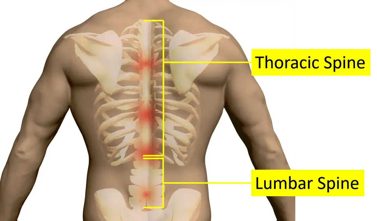 Anatomia kręgosłupa piersiowego z zaznaczonymi obszarami bólu, sugerującymi potencjalne objawy neurologiczne.
