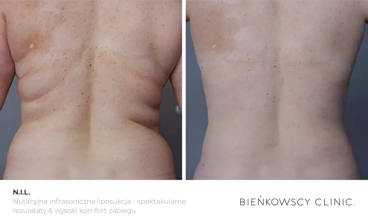 Przed i po zabiegu N.I.L. - innowacyjna liposukcja, która pokazuje, co to jest liposukcja i jej spektakularne efekty.