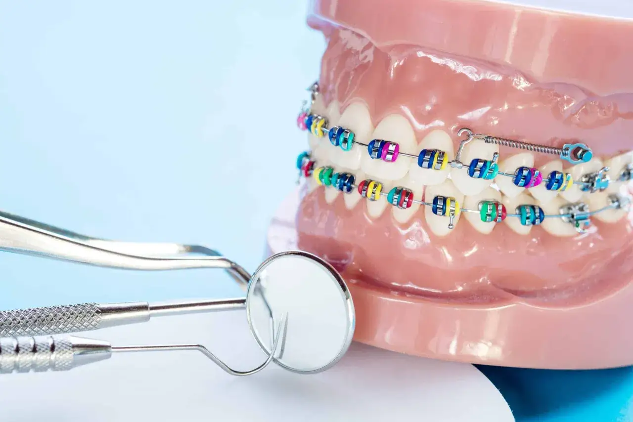 Kolorowy aparat na zęby na modelu szczęki, obok narzędzi dentystycznych. To może być najtańszy aparat na zęby, który pozwoli na piękny uśmiech.
