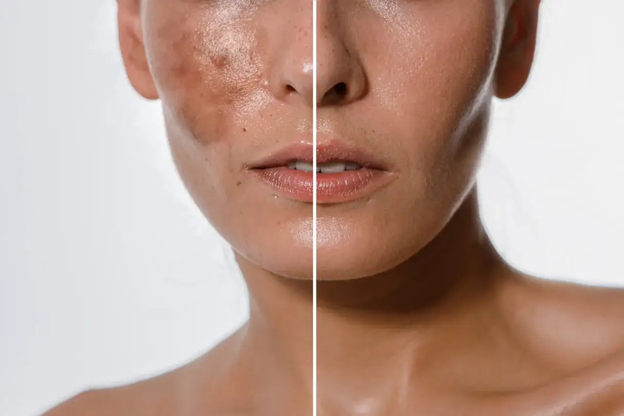 Comparaci&oacute;n de piel: antes y despu&eacute;s del tratamiento para el melasma que es una condici&oacute;n de hiperpigmentaci&oacute;n.