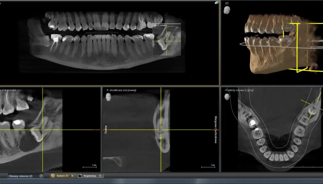 Planowanie chirurgiczne usuwanie ósemki w ciąży. Tomografia komputerowa szczęki pokazuje zęby i kości w przekrojach 2D i 3D.