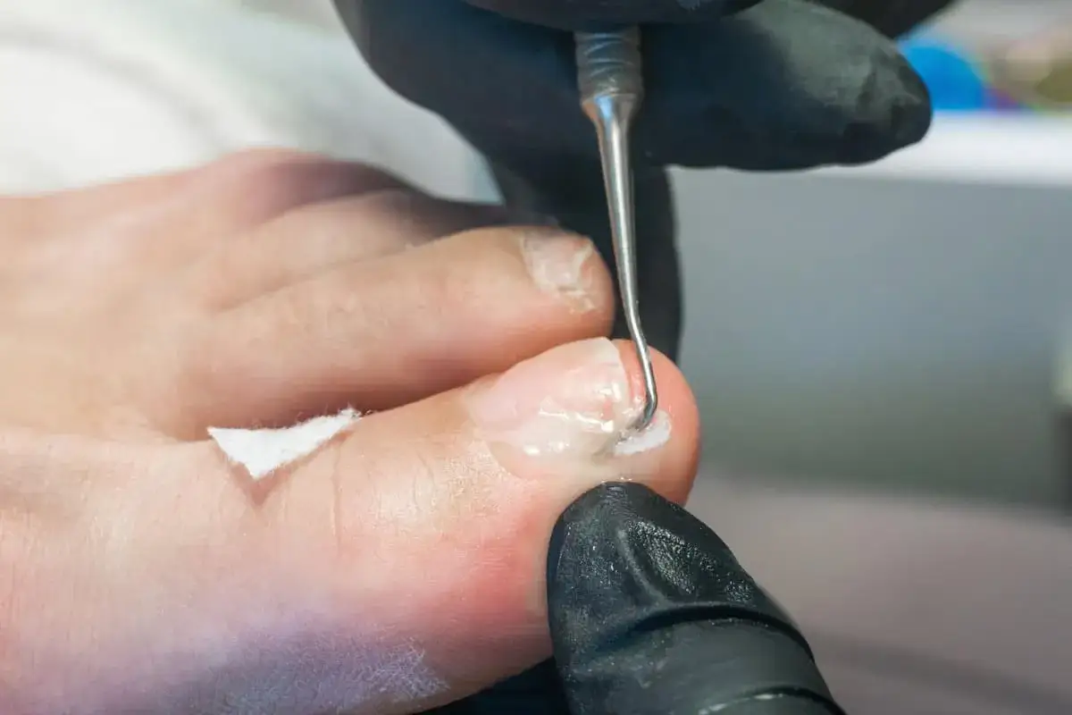Un podologue utilise un outil pour nettoyer un ongle de pied, une &eacute;tape essentielle pour un remboursement de pedicure r&eacute;ussi.