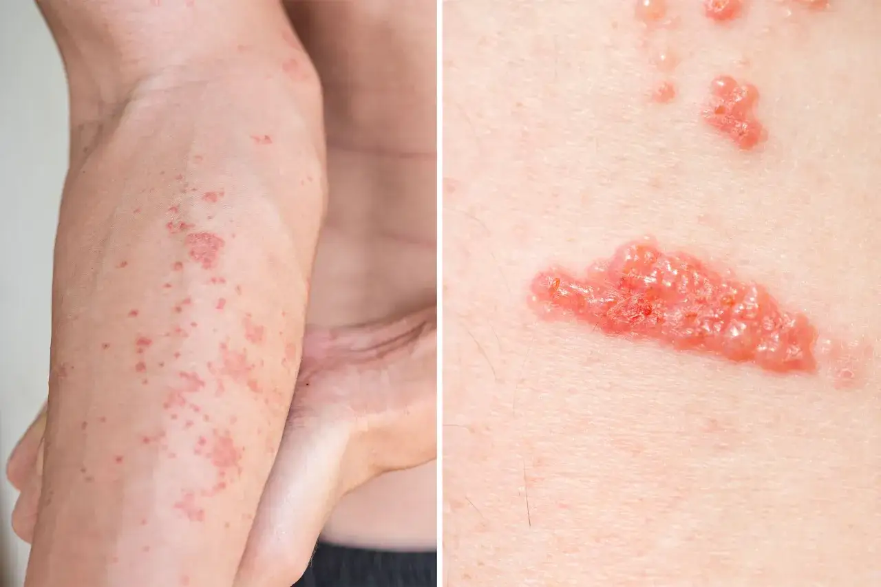 Dermatite da contatto: eruzioni cutanee rosse e vescicole. Scopri i rimedi per alleviare il prurito e l'infiammazione.