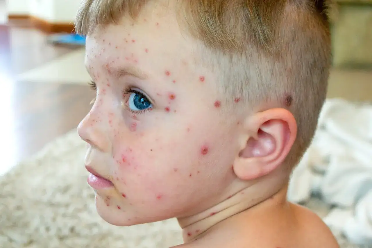 Niño con varicela, su rostro y cuello cubiertos de pequeñas erupciones rojas.