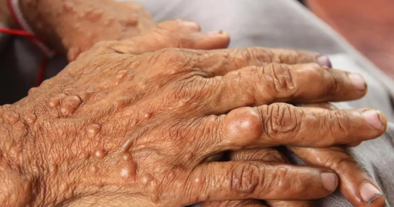 Dłonie osoby z neurofibromatozą, pokryte licznymi guzkami i zmianami skórnymi.