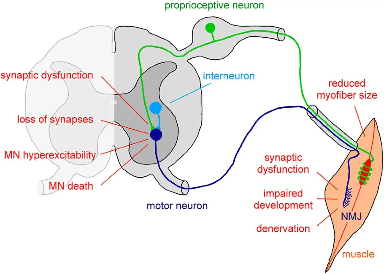 Diagrama de la atrofia muscular espinal, mostrando disfunci&oacute;n sin&aacute;ptica, p&eacute;rdida de sinapsis y muerte de neuronas motoras.