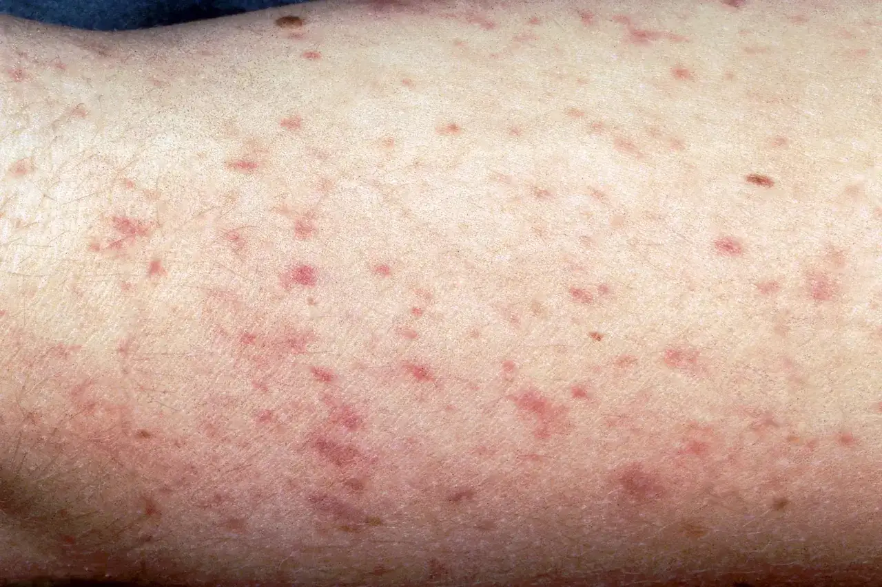 Piel con erupci&oacute;n petequial, un posible s&iacute;ntoma de meningitis.