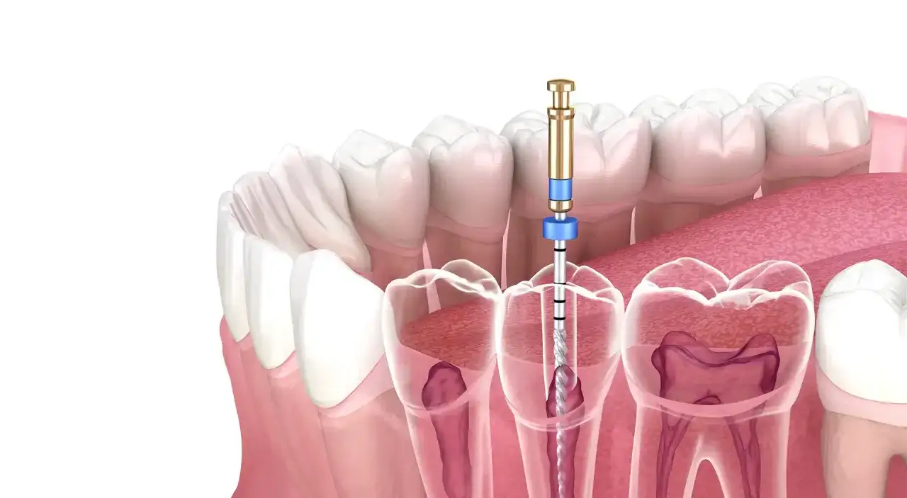 Strumento dentistico in azione per la devitalizzazione di un dente, mostrando la pulizia dei canali radicolari.