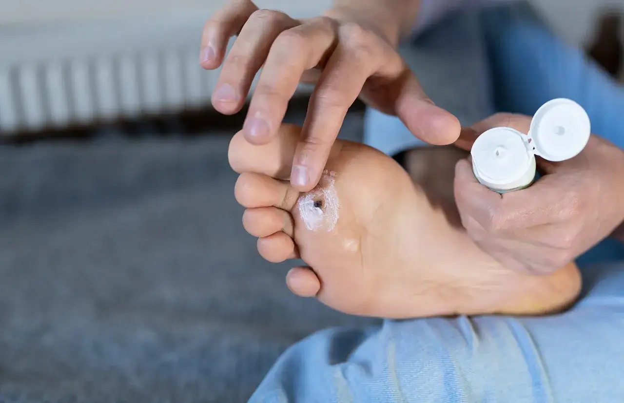 Application d'une cr&egrave;me &agrave; l'acide salicylique sur une verrue plantaire.