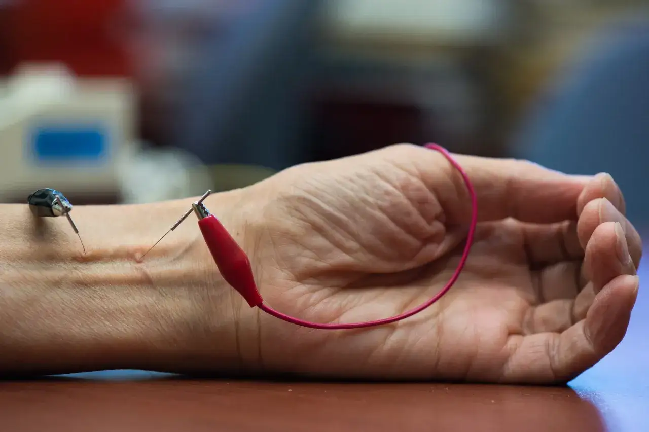 Acupuncture sur le poignet, une m&eacute;thode de point massage hypertension, avec des aiguilles connect&eacute;es &agrave; des fils.