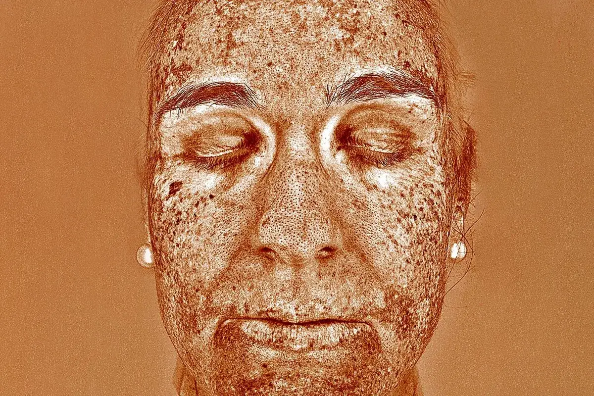 Rostro con piel marcada por elastosis solar, mostrando manchas y textura irregular bajo luz especial.