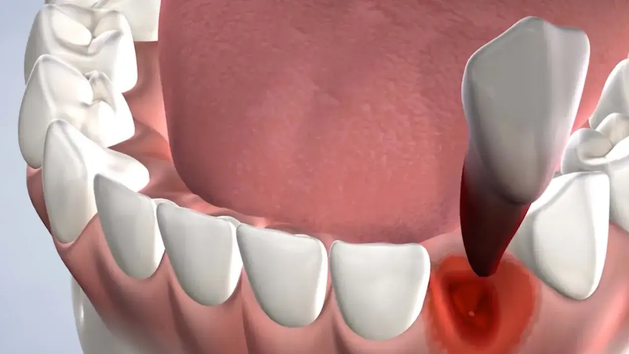 Ilustración de una boca mostrando el proceso de extracción dental, con un diente siendo removido y la encía inflamada.