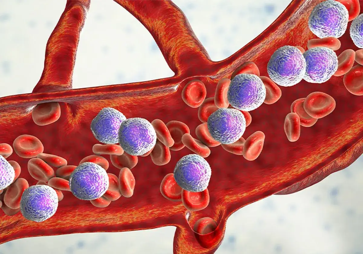 Cellule tumorali viola, indicative di leucemia linfoblastica acuta, circolano tra i globuli rossi in un vaso sanguigno.