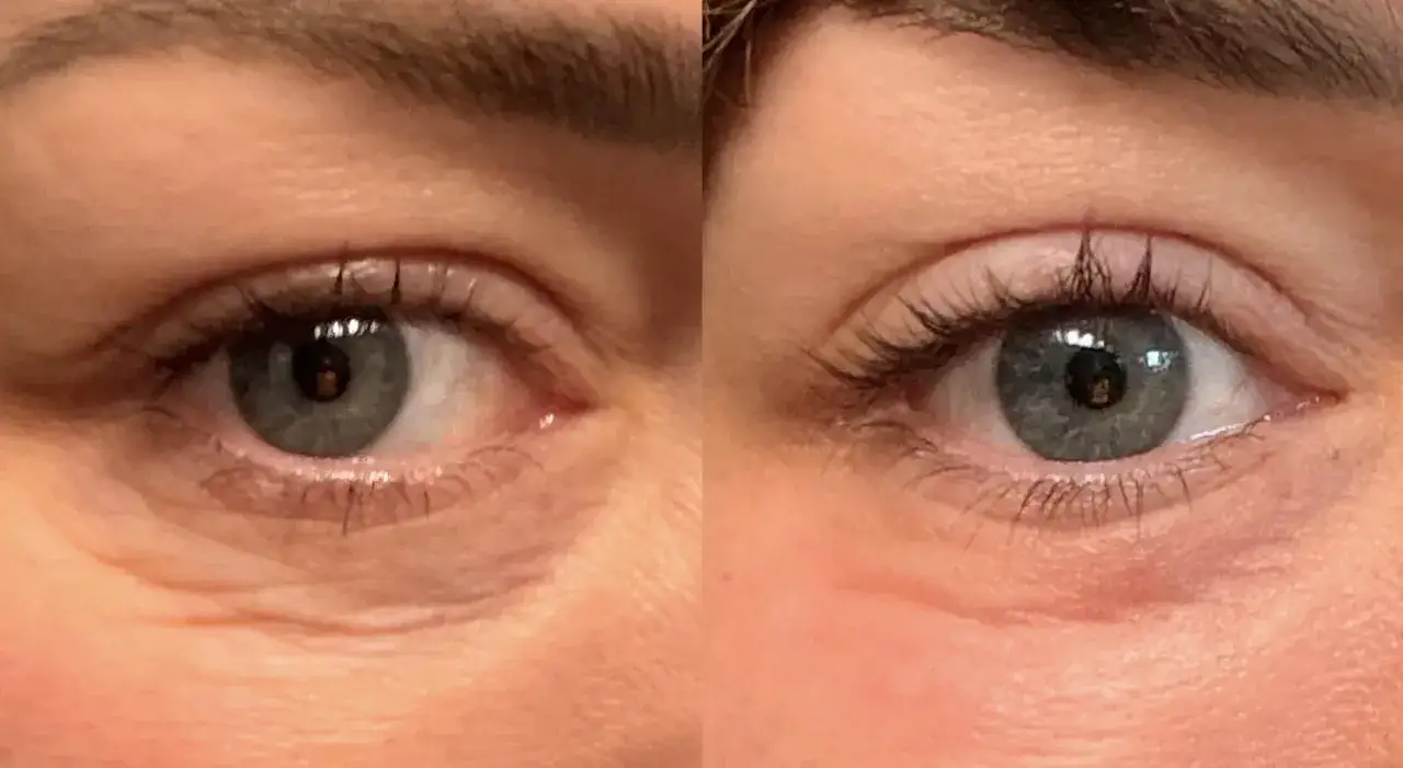 Occhi prima e dopo peeling TCA: rughe attenuate e pelle pi&ugrave; liscia.